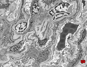 M,40y. | collapse of capillary loops